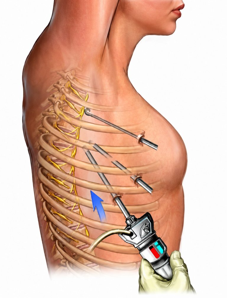 Thoracoscopy